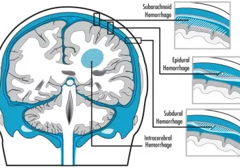 TBI_types